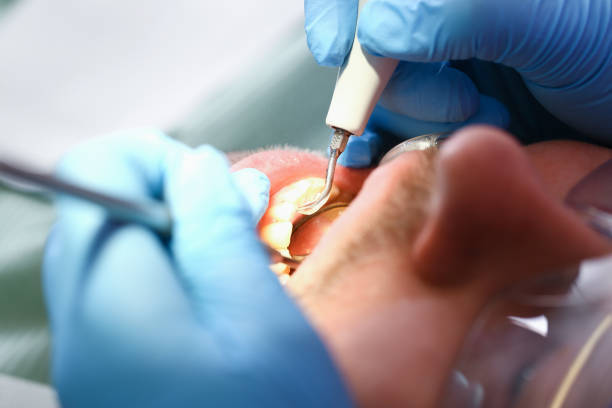 Best Emergency Root Canal Treatment in Stanley, ND